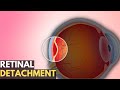 Retinal detachment everything you need to know