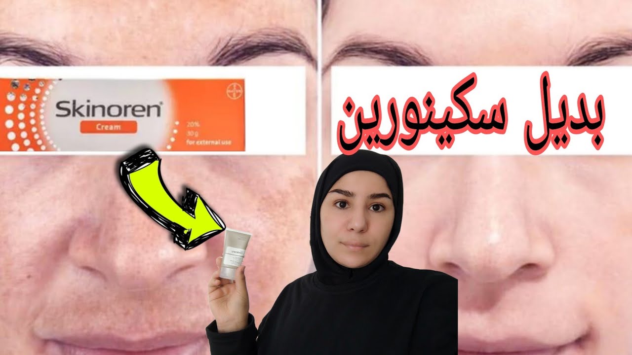 البديل الٱمن لعلاج الكلف و التصبغات✌️مالقيتيش سكينورين غنعطيك البديل/نفس المفعول/نتائج مبهرة و سريعة