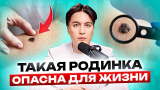 Как распознать ОПАСНУЮ родинку? 5 признаков меланомы!