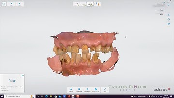 Intra-Oral Scans for Immediate Denture Fabrication