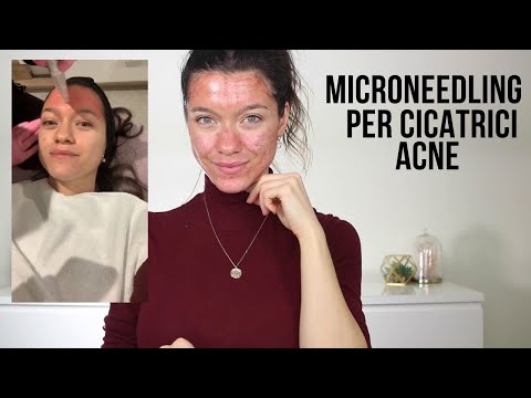 Cicatrici Acne, Microneedling Esperienza e Update La Mia Pelle è Perfetta?