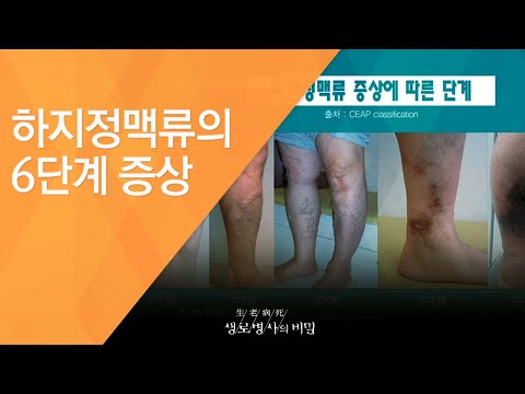 하지정맥류의 6단계 증상 - (2016.10.12_597회 방송)_울퉁불퉁 튀어나온 핏줄 하지정맥류