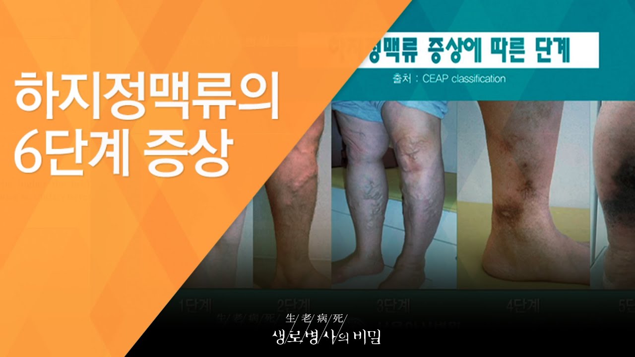 하지정맥류 원인 과거와 다른 부분은 명의와 함께 알아보세요! 3