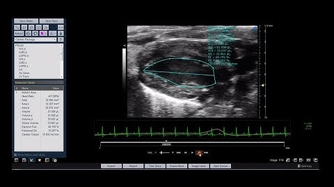 Auto LV Analysis using Vevo LAB