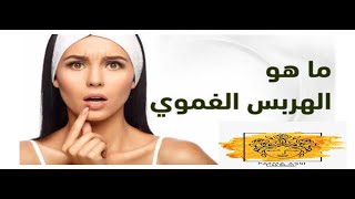 ما هو فيرس الهربس الفموي اسبابه و طرق علاجه