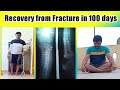 Recovery from fracture in 100 days  tibial and fibular head fracture  leg fracture recovery