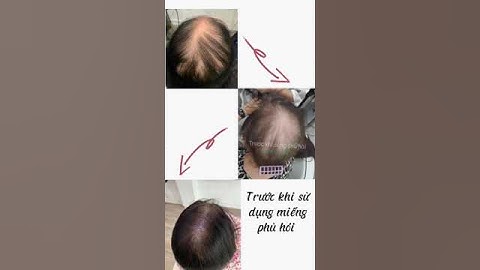 tóc giả siêu da đầu như thật, chia ngôi tứ phía. phủ hói, làm dày tóc, người bị rụng tóc