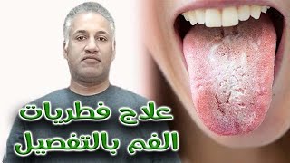 علاج فطريات الفم واللثة بالتفصيل