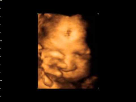 36 haftalık gebelik ve 4D ultrason.
