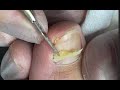 Remove so much old nail under nail to relief the pressure for client