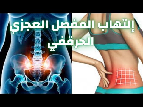 التهاب المفصل العجزي الحرقفي علاج التهاب المفصل العجزي الحرقفي دكتور احمد حسن جمعه