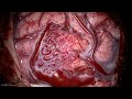 Microsurgical resection of a lateral parietal arteriovenous malformation