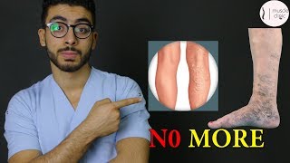 ما هى دوالى الساقين ؟! - علاج مشكلة الدوالى نهائيا  varicose veins treatment