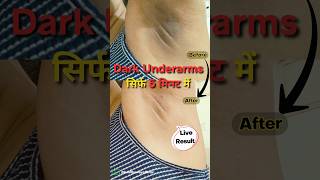 How to get rid of dark underarms | dark underarms home remedy | Underarms का कालापन दूर करें shorts