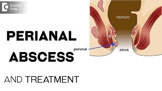 What is perianal abscess and its treatment? - Dr. Prashanth Varadaraju screenshot 4