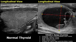 ACR TIRADS Classification Of Thyroid Nodules Ultrasound | Thyroid Imaging Reporting and Data System