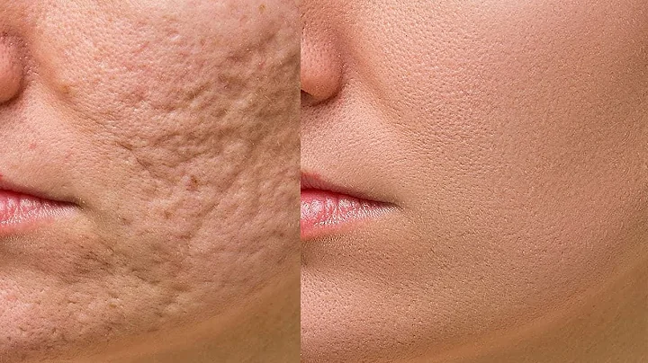 High-End Skin Retouching Beginner Photoshop Tutorial | Frequency Separation