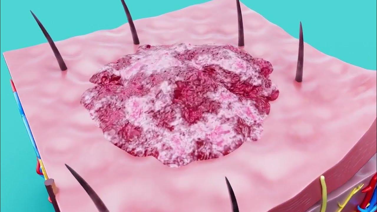 Jigger Removal Treatment and Prevention for Tungiasis YouTube