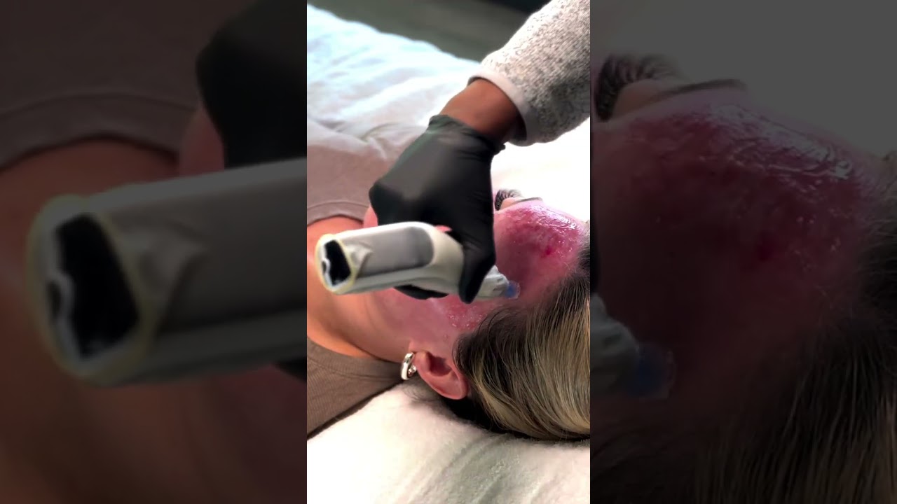 STRENGTHENING THE DERMAL-EPIDERMAL JUNCTION ✨ MICRONEEDLING FOR SKIN REPAIR & RESILIENCE!