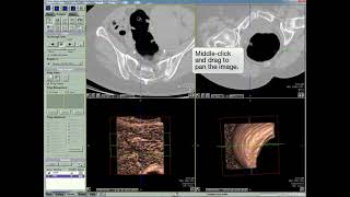 Colon 2D Scroll Through the MPR Views Demo