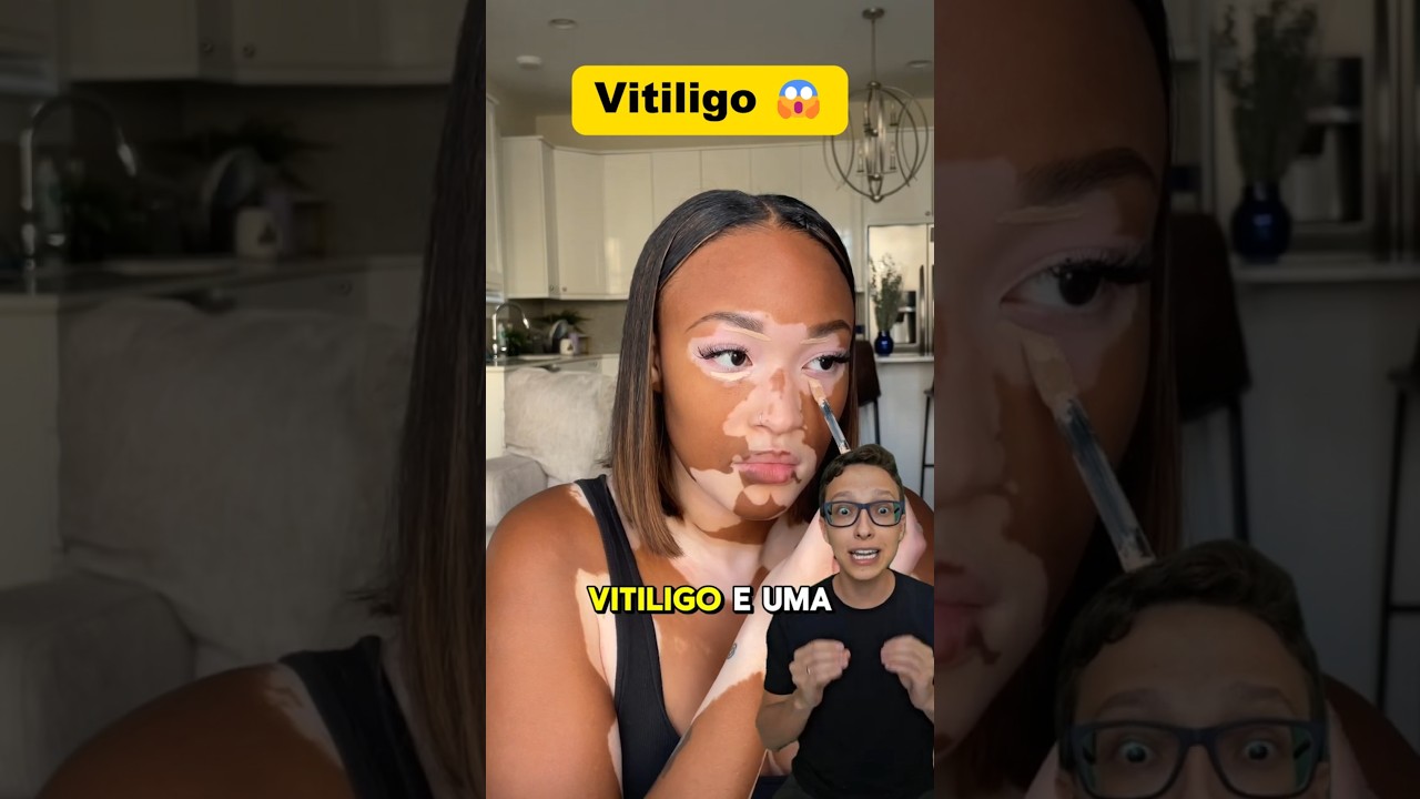 Vitiligo 😱 #medicina #medico #enfermagem #enfermeiro #enfermeira #vitiligo #dermatologia causas de