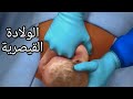 Pregnant woman Baby Birth | الولادة القيصرية