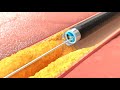 Peripheral Artery Disease Catheter - Infuse Medical