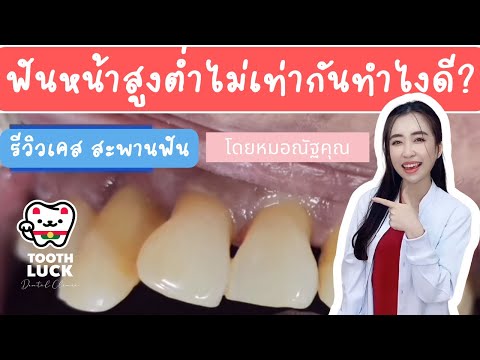 ฟันหน้าสูงต่ำไม่เท่ากัน ทำยังไงดี? รีวิวเคสสะพานฟัน - หมอณัฐคุณ