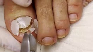 Fungal Nail with Dried Abscess 🦶 Ingrown Nail Treatment 🦶 Thick Fungal Toenail