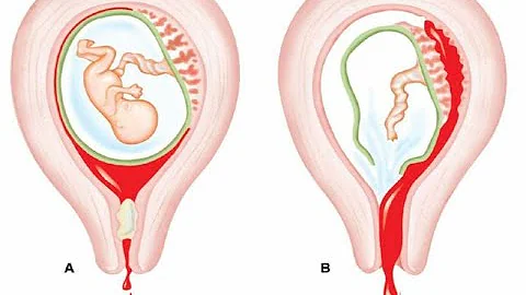 ¿Cuáles son las causas de los abortos recurrentes?