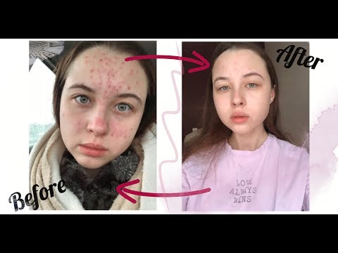 Video: Klenzit-S - Instructions, Application For Acne, Reviews, Price, Analogues