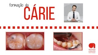Carie dentária: veja como a carie é formada
