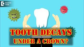 What to do when a tooth decays under a crown? - Dr. Ranjani Rao