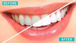 CARA MEMUTIHKAN GIGI SECARA PERMANEN DALAM WAKTU SINGKAT (100% AMPUH) - Durasi: 5.46. 