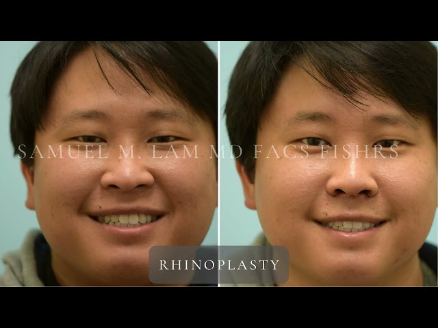 Dallas Cosmetic Surgery | Rhinoplasty | Patient Testimonial