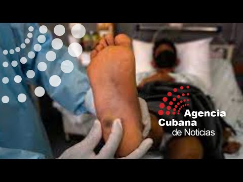 Cuba está preparada para enfrentar viruela símica