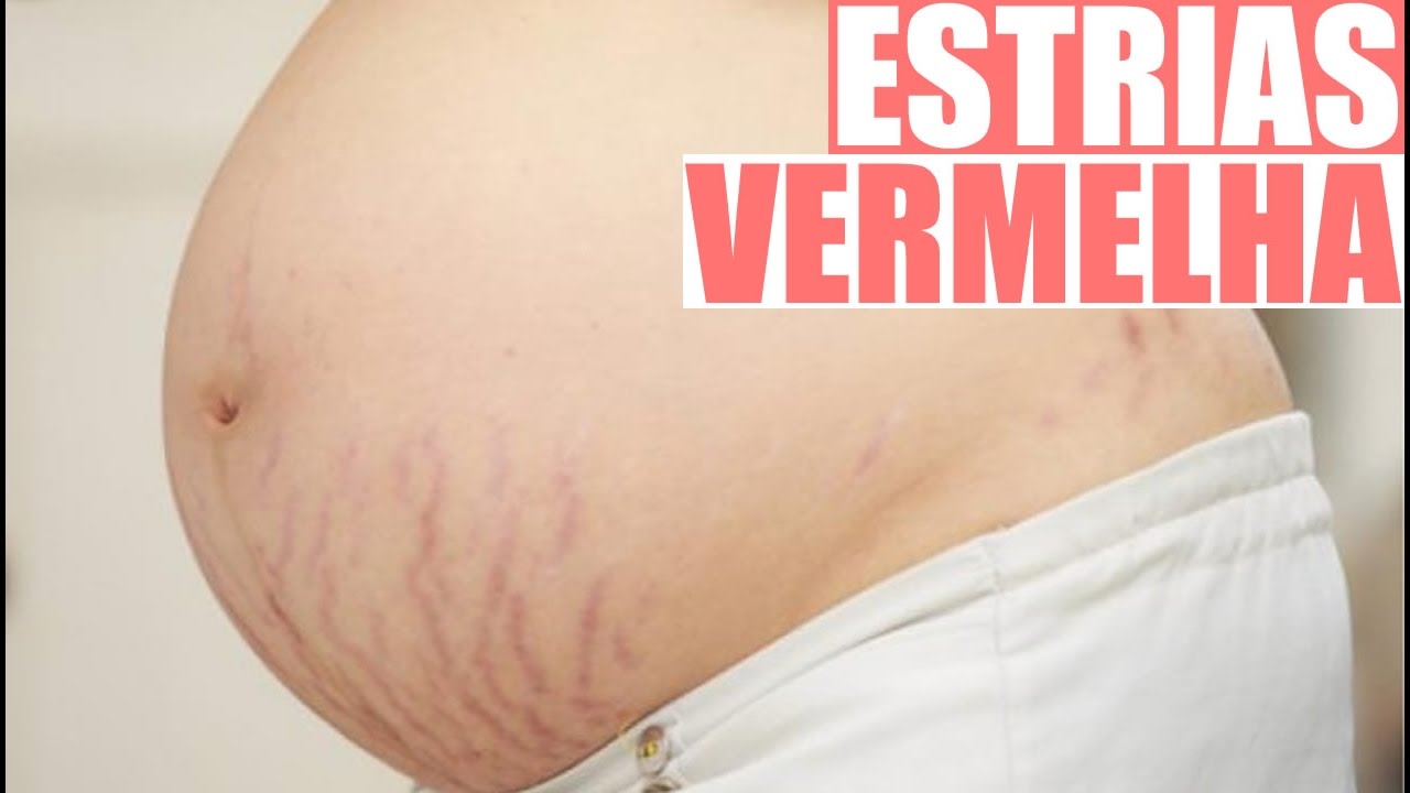 Estrias Vermelhas Como Tratar – Tipos De Estrias: Entenda As Variações ...