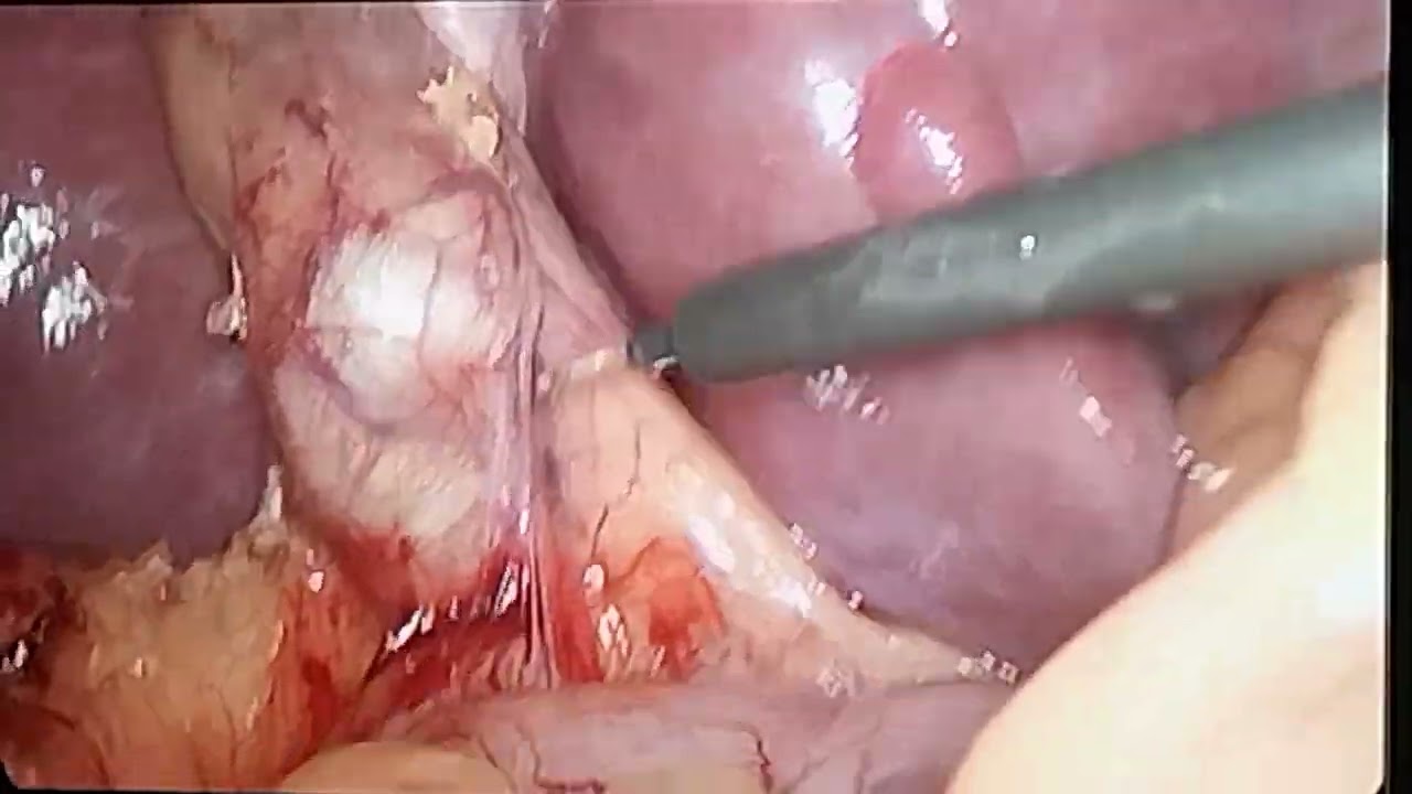critical view of safety in laparoscopic cholecystectomy