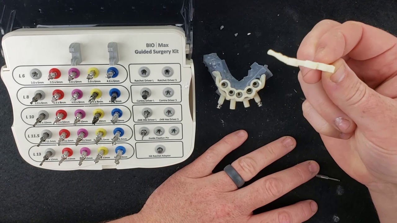 The Guide Bar Concept in Full Arch Implant Rehabilitation