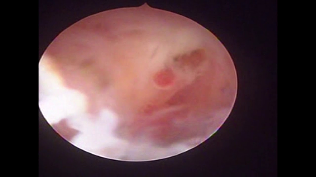camera iphone 8 plus apk Polipectomía cervical (endocervical múltiple)