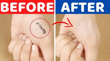 Easiest Way to Remove Permanent Marker, Sharpie from Skin with Toothpaste.