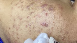 Acne Hidden Deep Under Young Mens Skin Mụn Ẩn Sâu Dưới Da - Sacdepspa