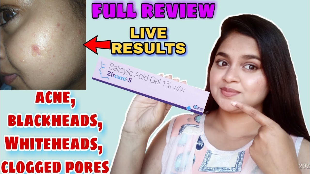 best salicylic acid gel review zitcare s gel for acne, blackheads