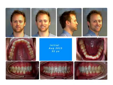 dental-treatment:-accelerated-orthodontics-feb,-27,-2018