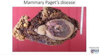 Breast Mammary Paget's Disease Breast Mammary Paget's Disease