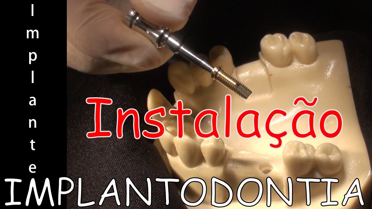 Instalação de Implante HE 3,75X13mm DSP - UFPE