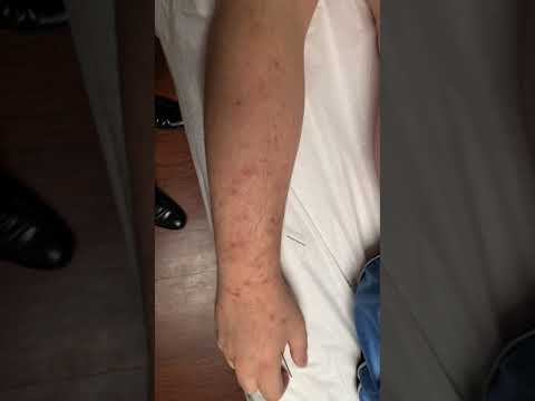 吡咯尿症的皮肤过敏和妊娠纹