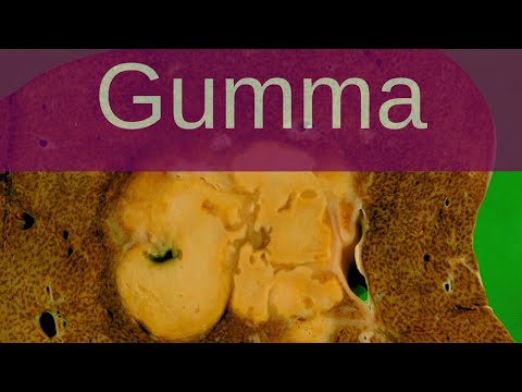 What is a Gumma? - Pathology mini tutorials