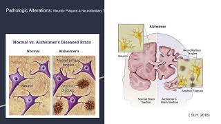 Alterations in Neurologic Function Alzheimers