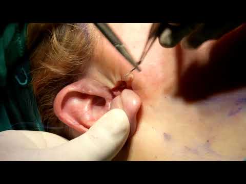 Βίντεο: Πέντε εκατοστά δέρματος αφαιρέθηκαν από το πρόσωπο του λάτρη της πλαστικής χειρουργικής